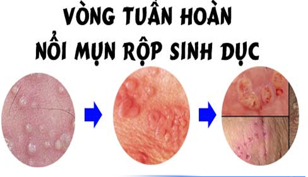 Các giai đoạn phát triển của mụn rộp sinh dục ở vùng kín